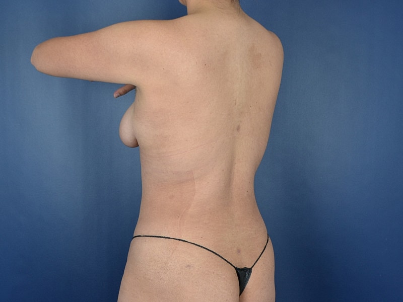 Liposuction Before & After