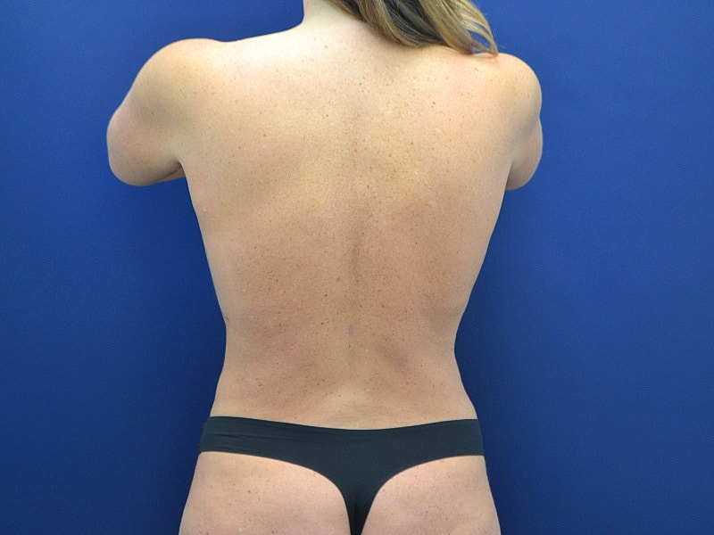 Liposuction Before & After