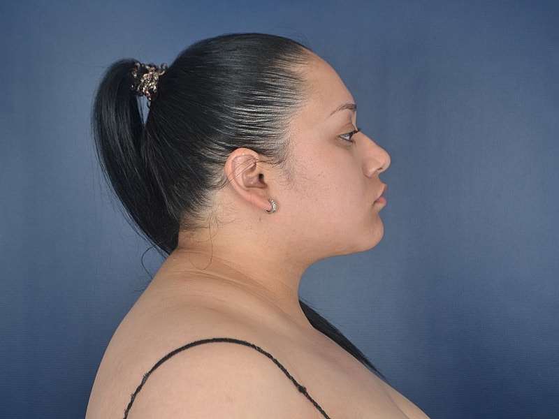 Liposuction Before & After