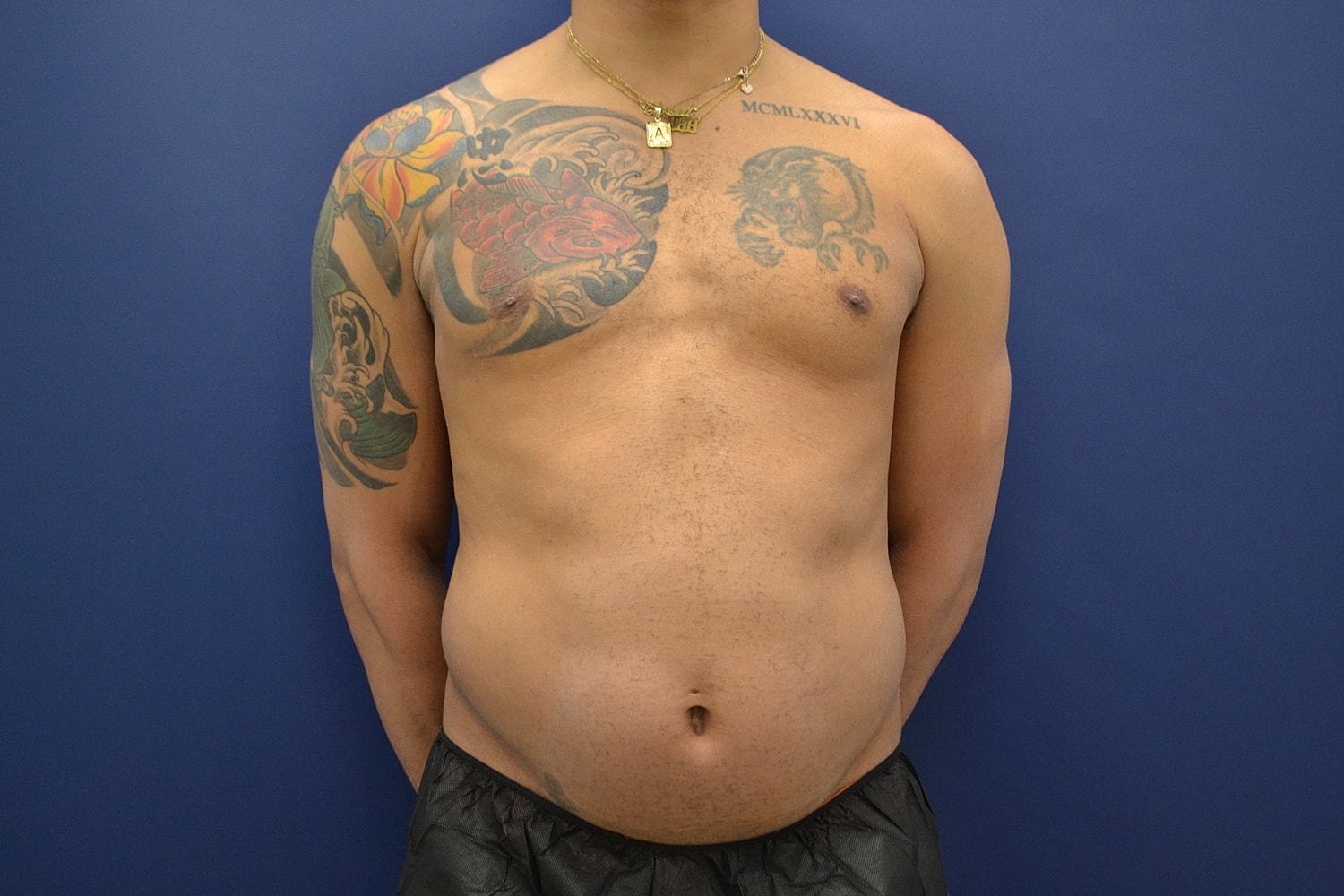 Liposuction Before & After