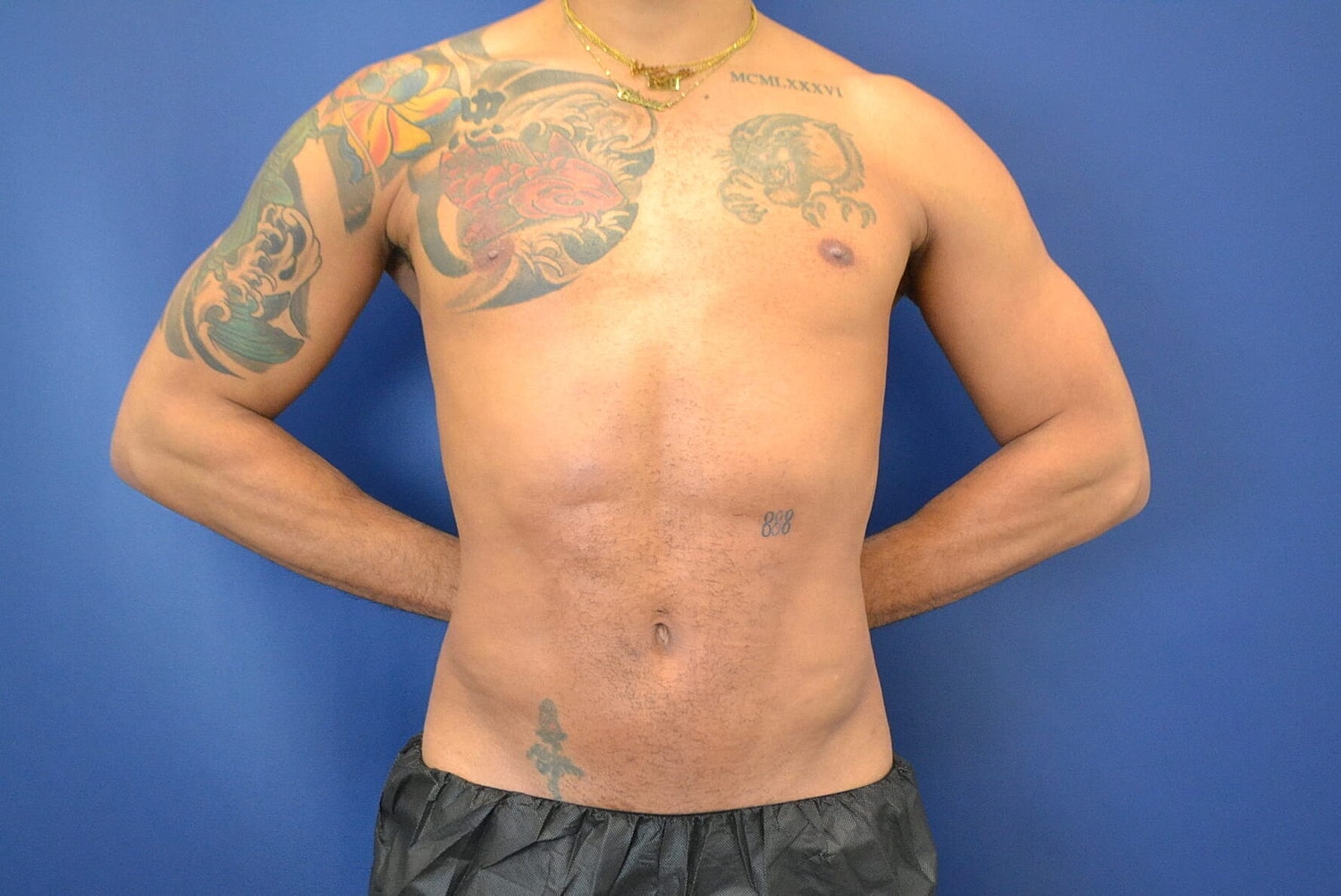 Liposuction Before & After