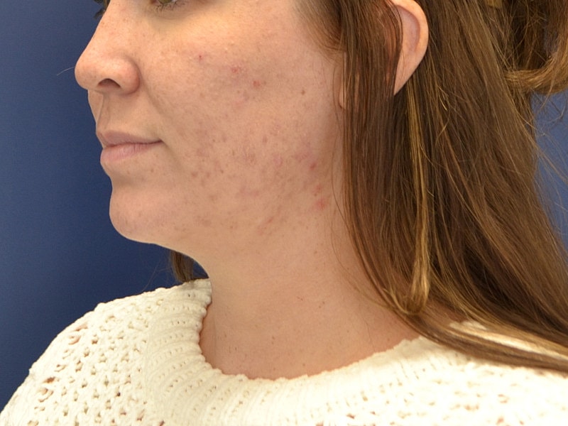 Liposuction Before & After