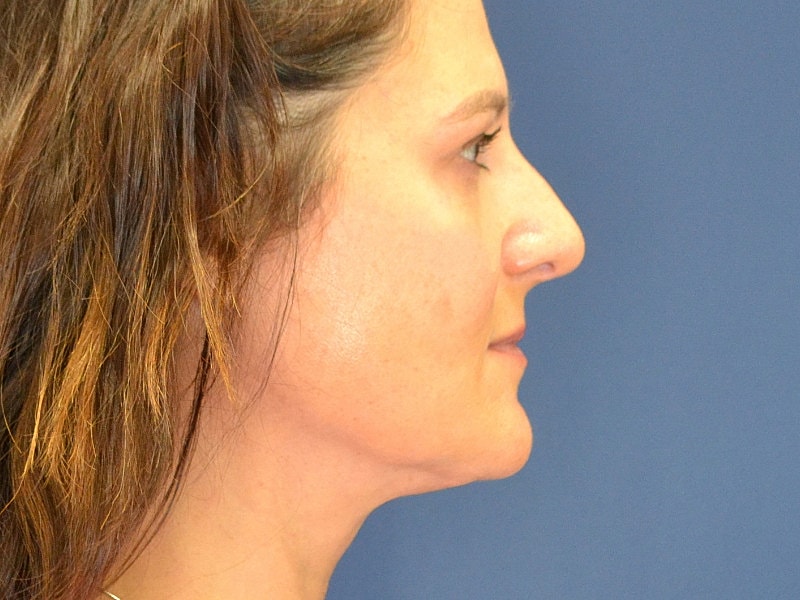 Liposuction Before & After