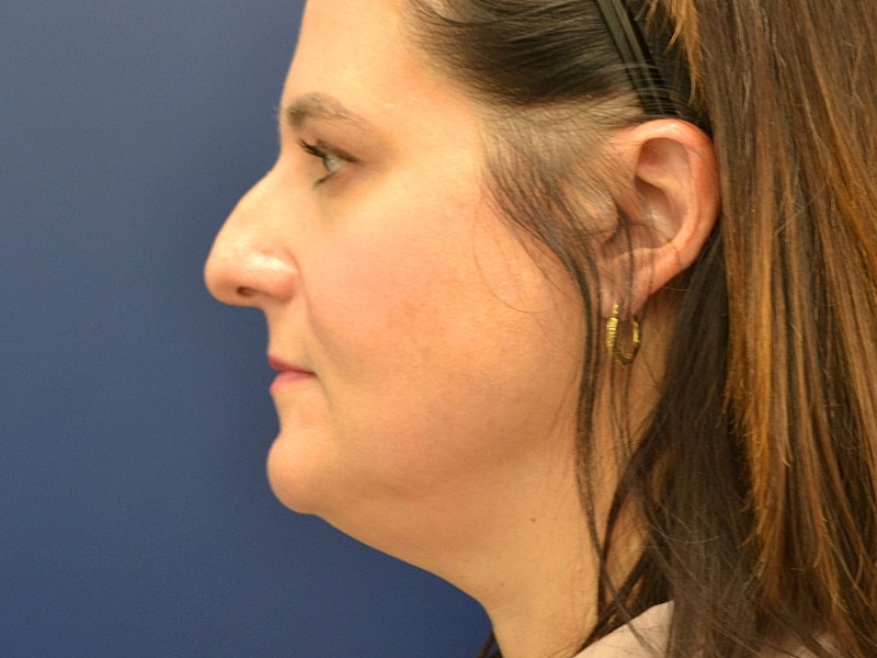 Liposuction Before & After