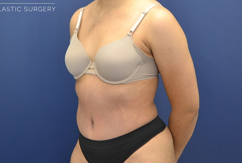 Liposuction Before & After