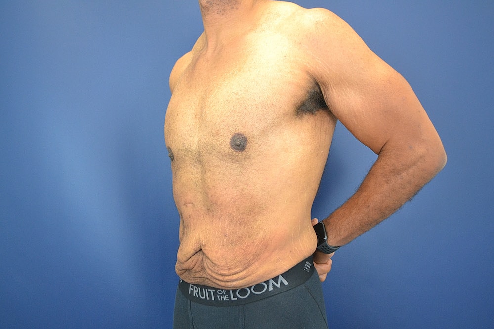 Liposuction Before & After