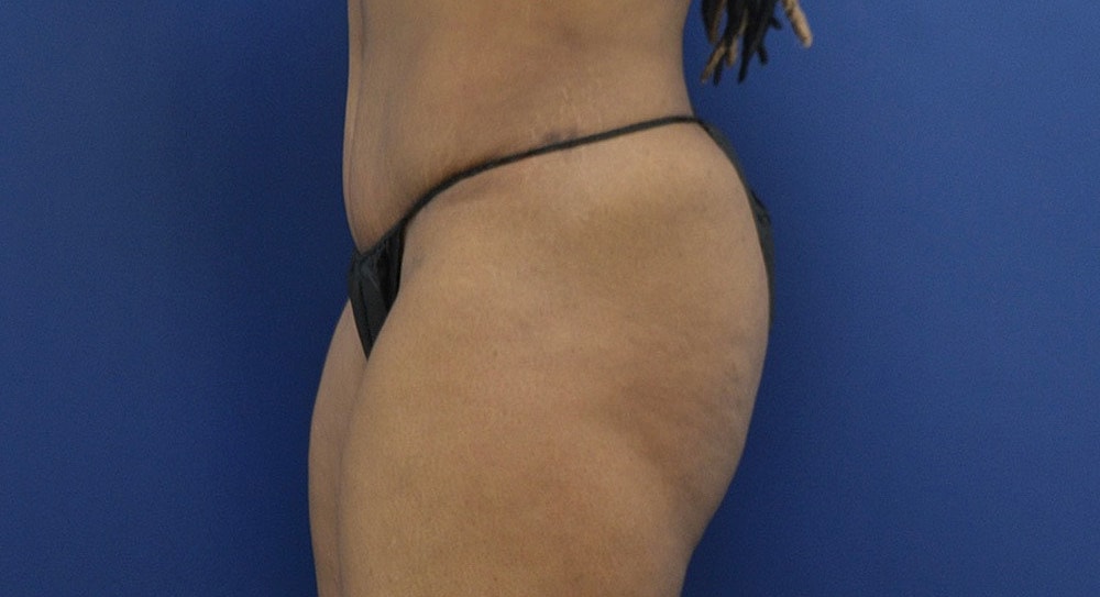 Brazilian Butt Lift Before & After