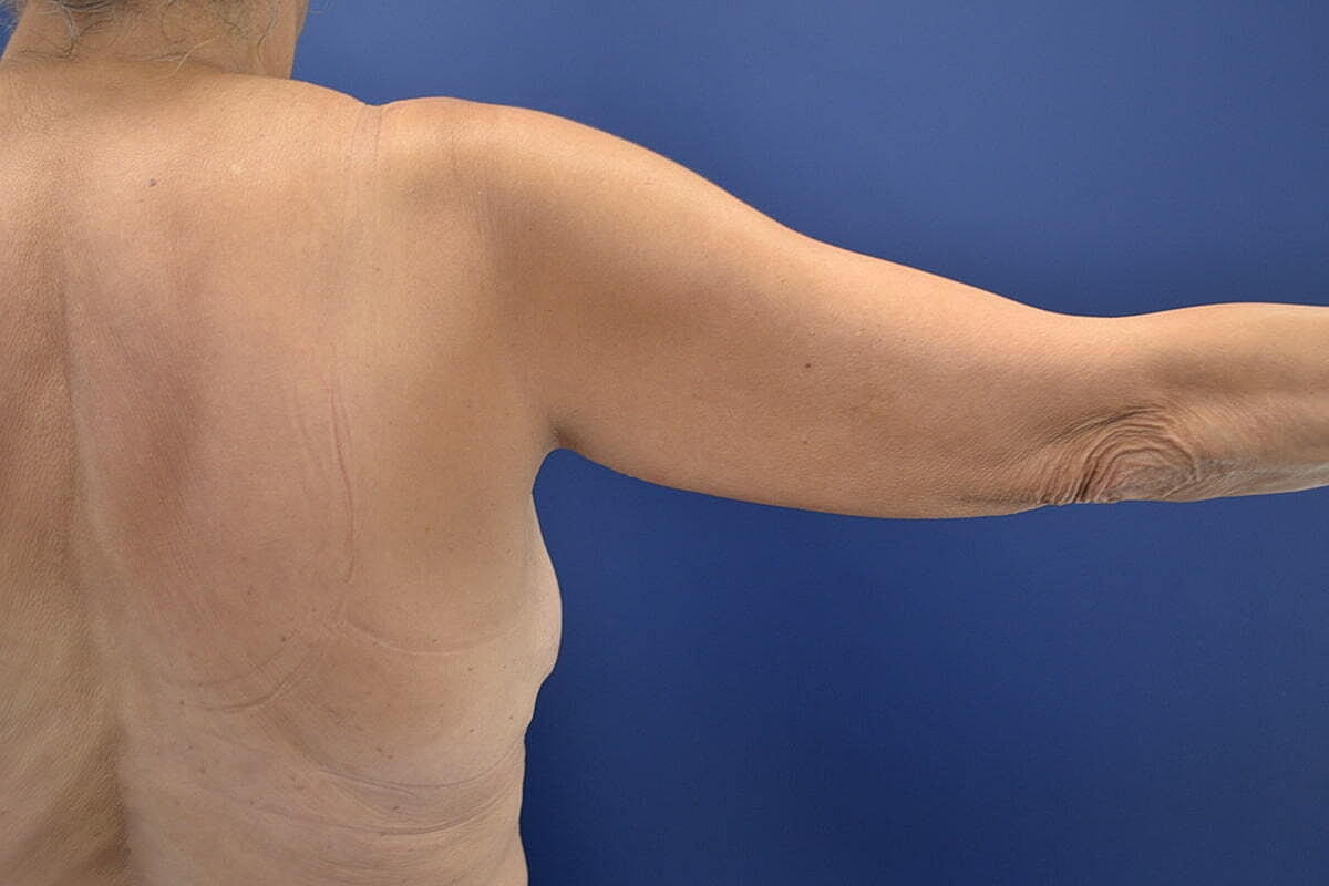 Arm Lift Before & After