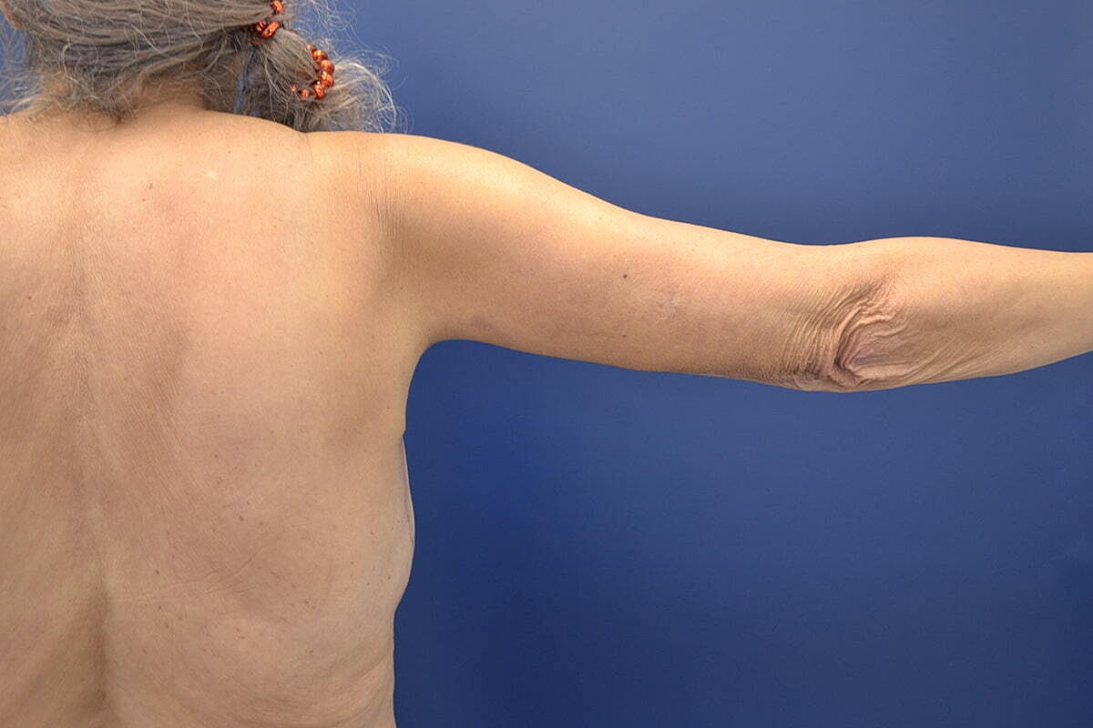 Arm Lift Before & After