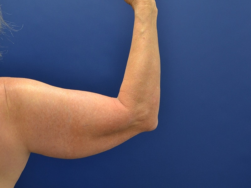 Arm Lift Before & After
