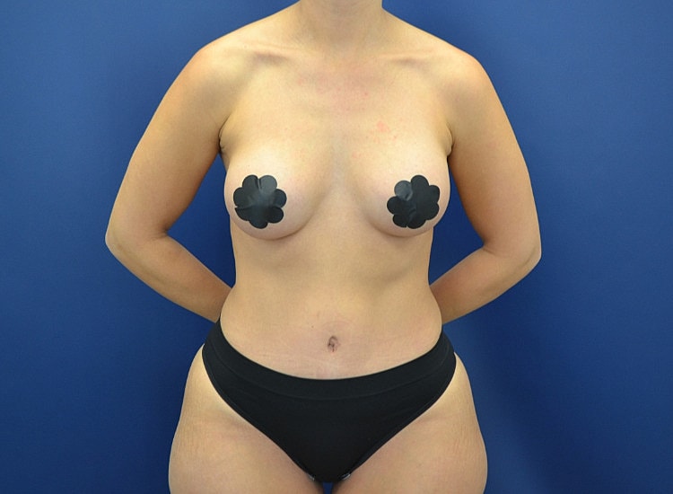 Tummy Tuck Before & After