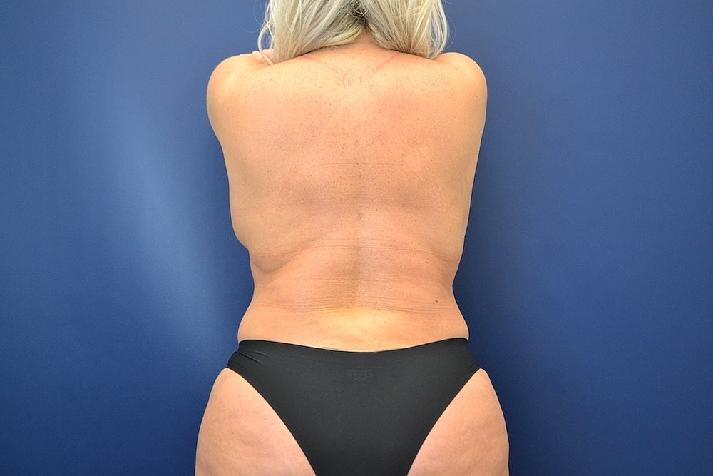 Tummy Tuck Before & After