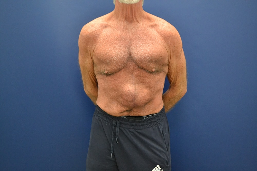Tummy Tuck Before & After
