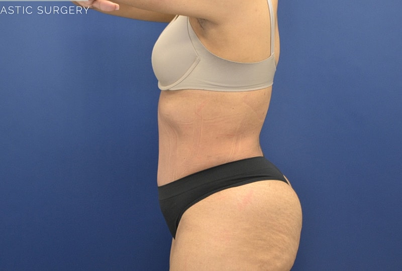 Tummy Tuck Before & After