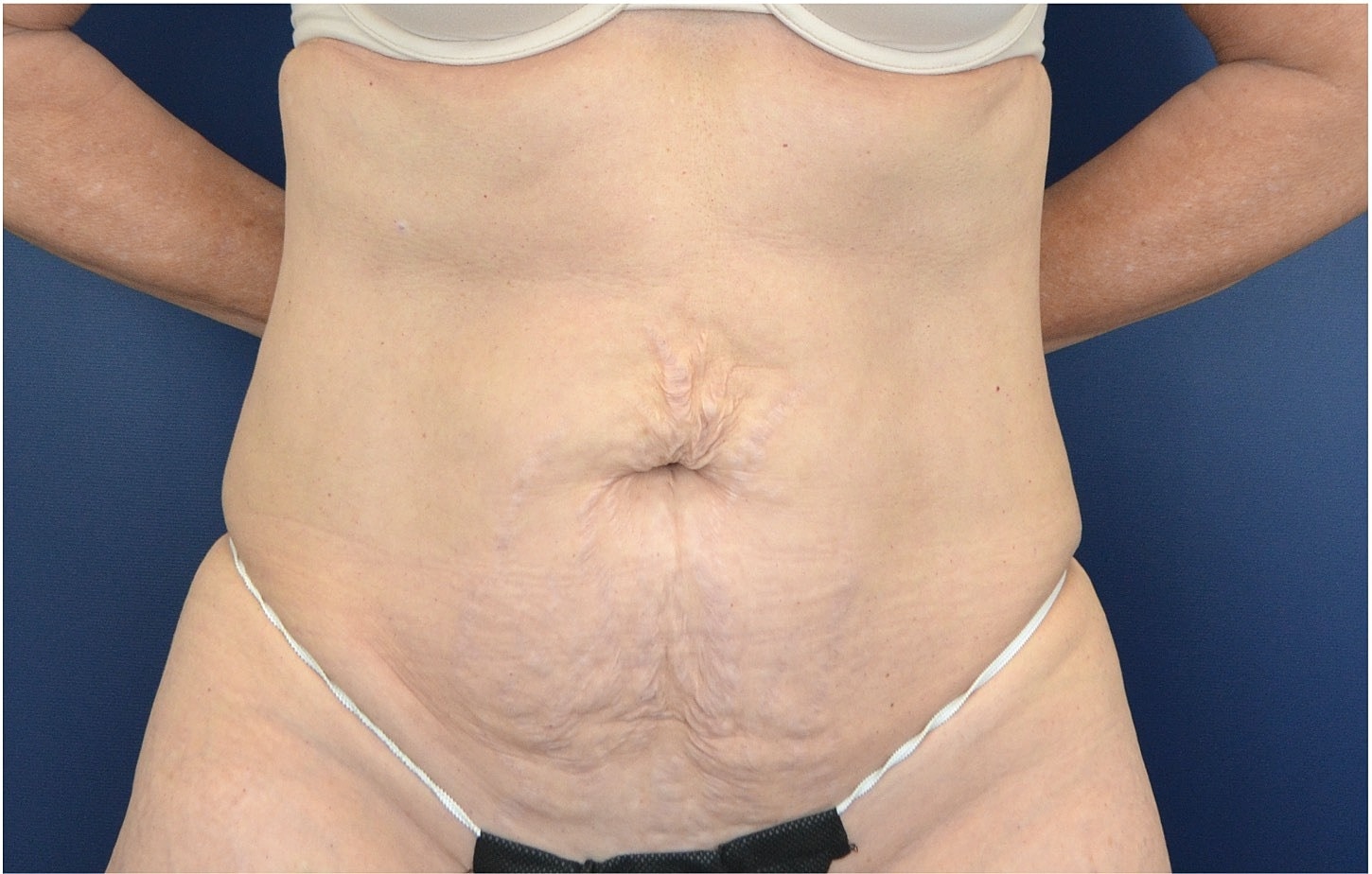 Tummy Tuck Before & After