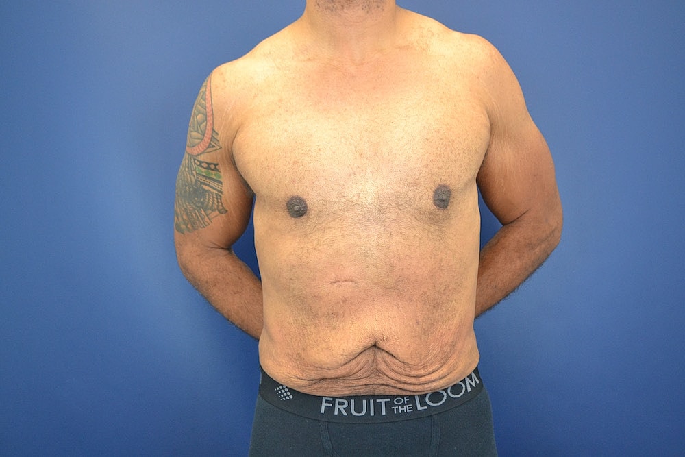 Tummy Tuck Before & After