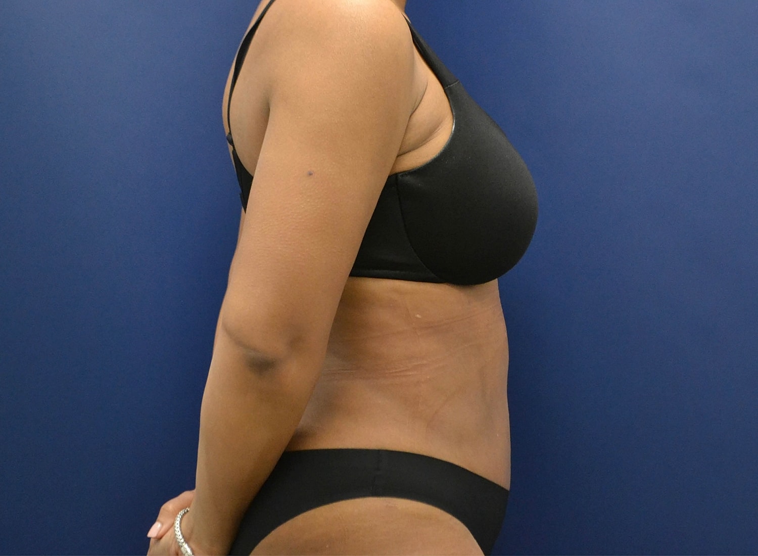 Tummy Tuck Before & After